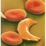 Globules rouges drépanocytaires