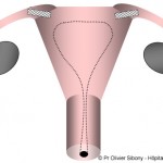 Dispositif intra-tubaire - contraception essure