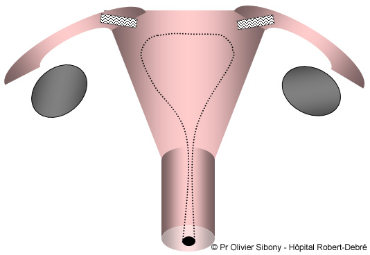 Dispositif intra-tubaire - contraception essure